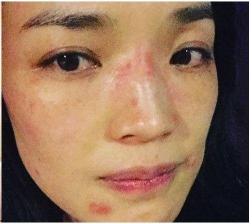 明星过敏住院吗,住院背后的健康警示